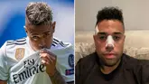 Real Madrid’s Mariano Justifies Decision to Run Down Contract With Facial Injury
